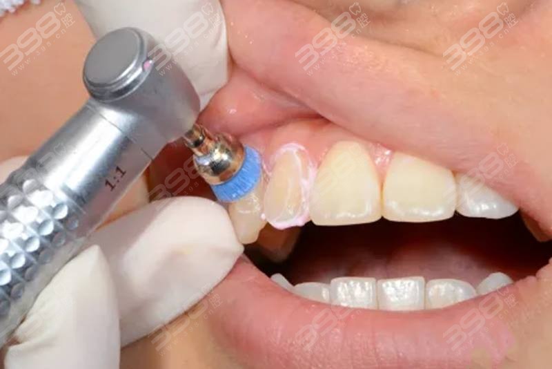 为什么医生不推荐洗牙 正常人千万不要洗牙