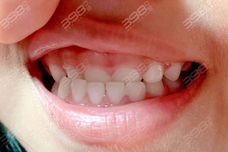 三次改善孩子牙齿不齐的重要时期
