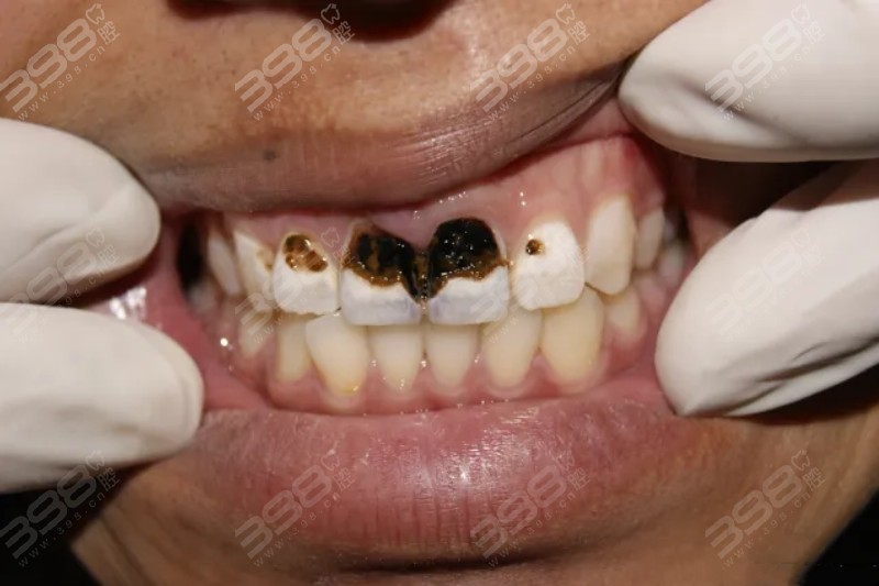 碳酸饮料腐蚀牙齿图片图片