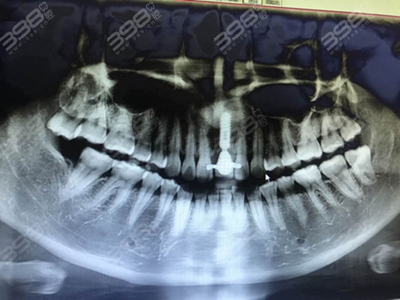 牙齿缺失修复-种植牙