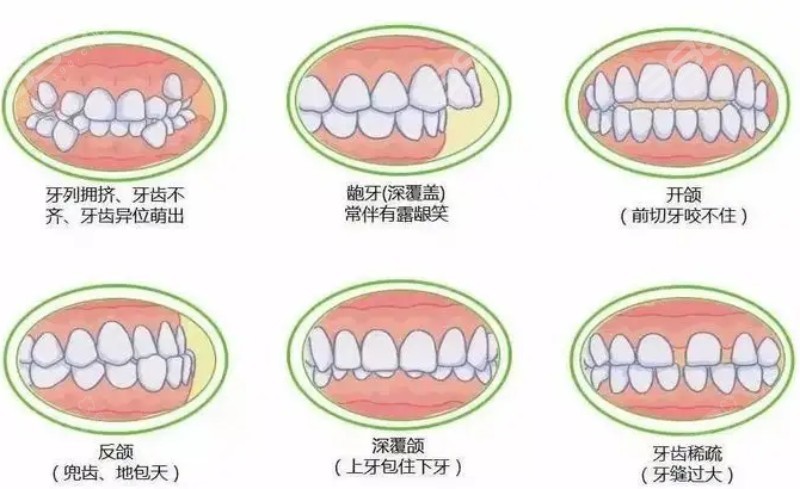 牙齿畸形的类型