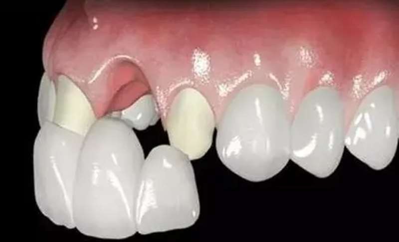 牙齿缺损或缺失后都有哪些修复方法？牙友们一般会选择哪种修复方式