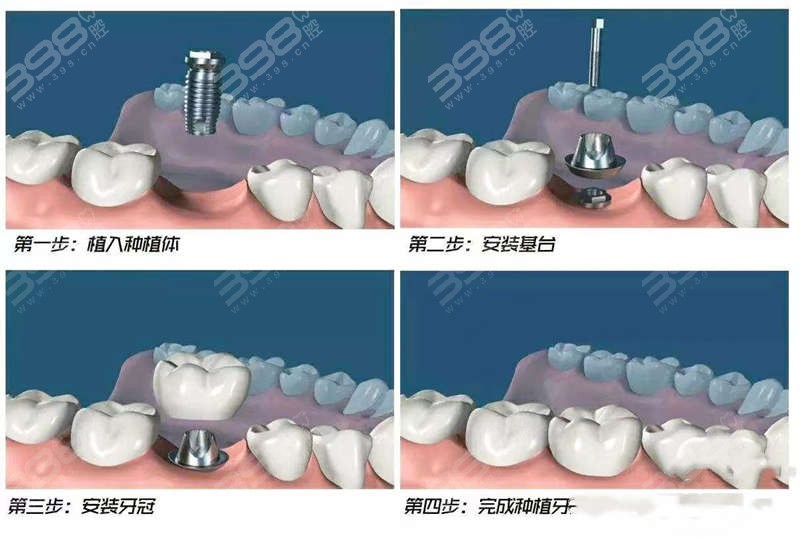 牙齿缺损或缺失后都有哪些修复方法