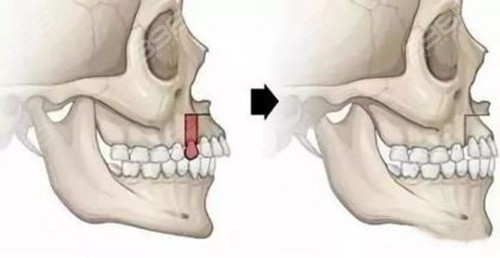 如何区分自己是骨性龅牙还是牙性龅牙
