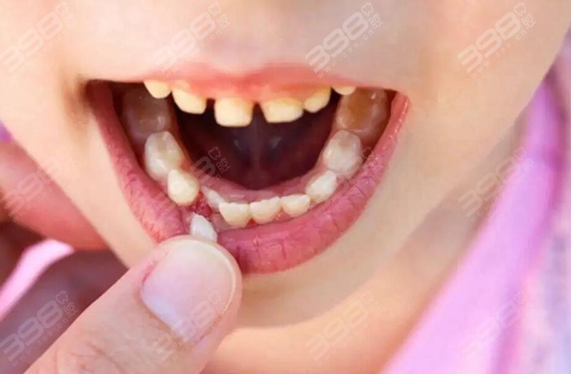 儿童换牙期