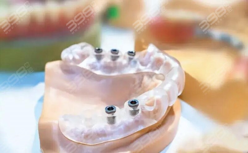 数字化导板种植牙手术过程