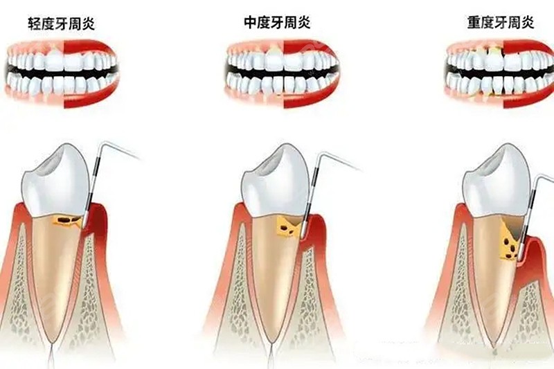 从牙周炎及症状图片对比自己牙齿情况 不同程度牙周炎治疗方式也不同