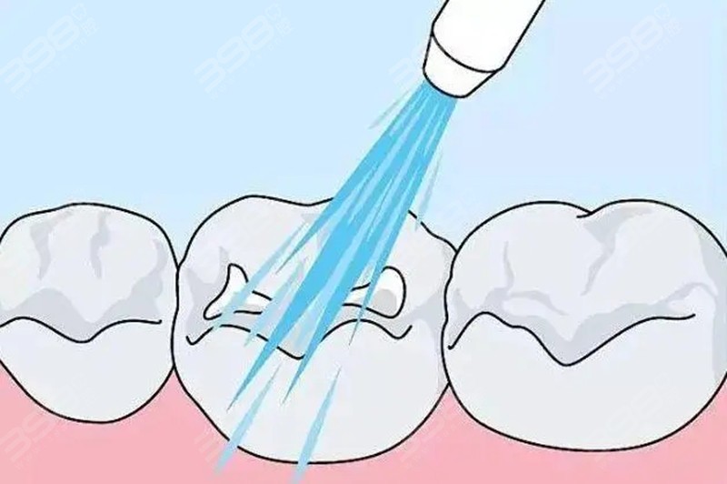 冲牙器可以清洁到牙窝