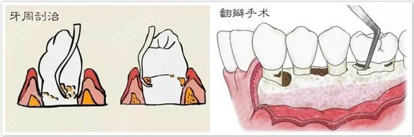 牙周炎翻瓣手术和龈下刮治