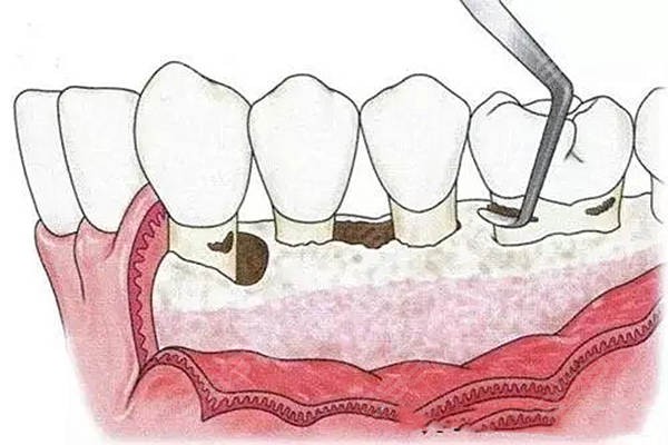 牙周炎翻瓣手术全过程是什么？看完再也不敢忽视牙周问题了