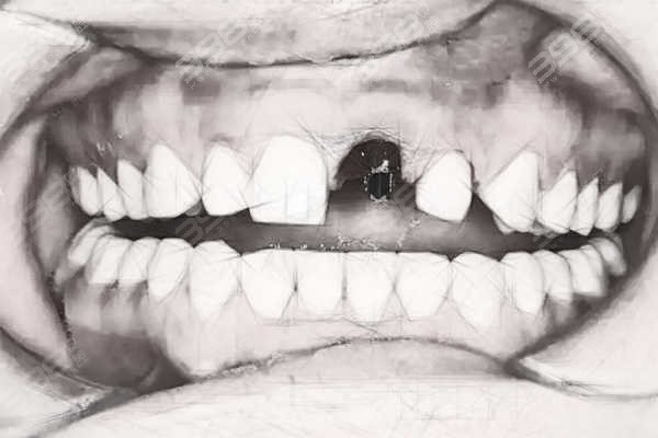 相恋多年才发现女朋友4颗门牙是假的 没想到种植牙这么仿生