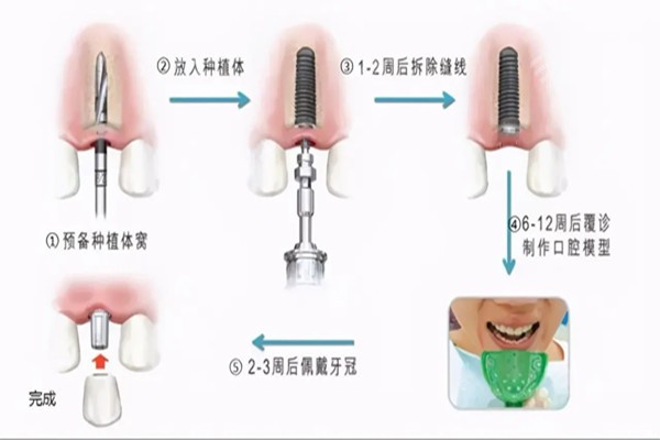 分享种植牙一期二期三期种植波折经历，和种植牙一期二期三期种植流程