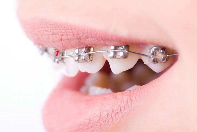 为什么在牙齿矫正前，医生还要进行洗牙、补牙和拔牙？