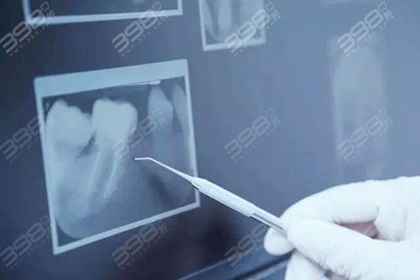 北京中诺口腔医院补牙价格之根管治疗多少钱