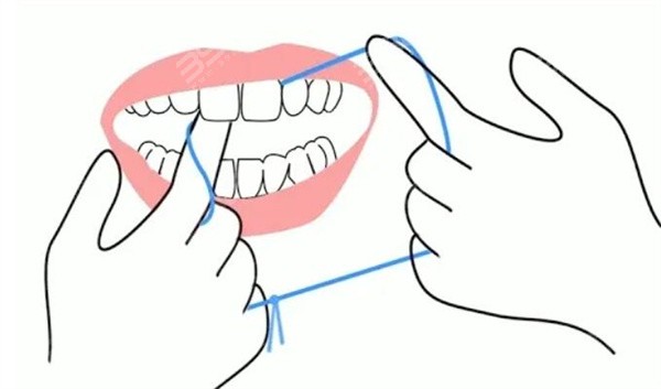 牙线辅助