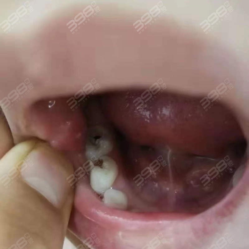 幼儿龋齿有必要补牙吗？