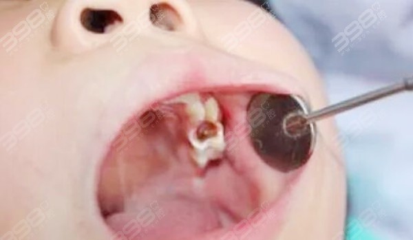 孩子乳牙有牙洞需要补吗？