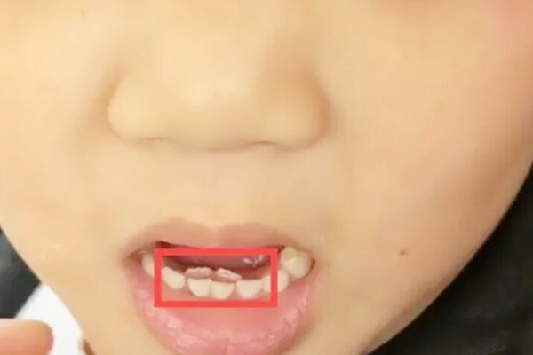 6岁女童长出“双排牙”，医生表示：跟吃的东西有关