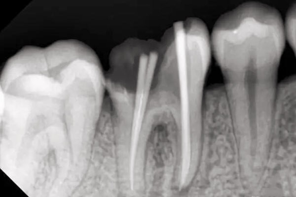 宁波根管治疗多少钱一颗牙?前牙/后磨牙/显微根管收费标准不同