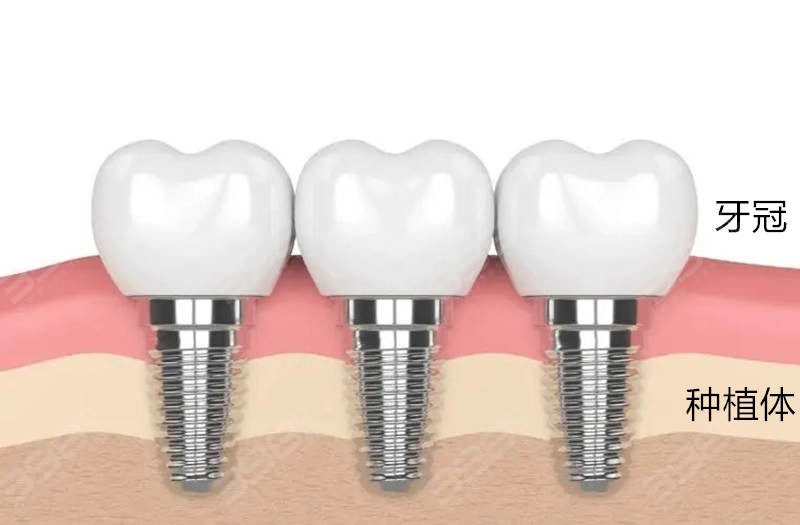 安装了种植牙能不能做核磁共振？种植体/基台/牙冠对于核磁结果都没影响吗？