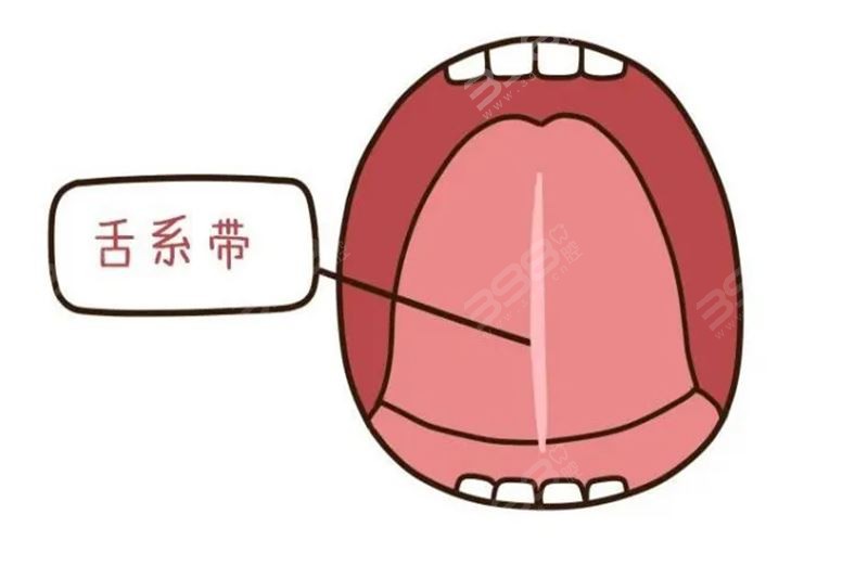 舌系带