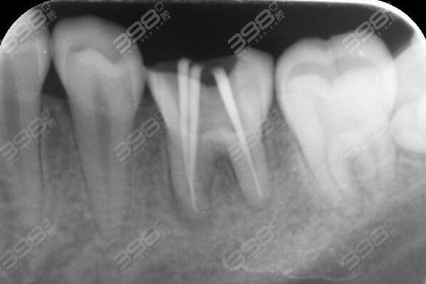 宁波根管治疗多少钱一颗牙?前牙/后磨牙/显微根管收费标准不同