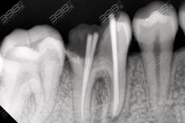 前牙根管治疗价格