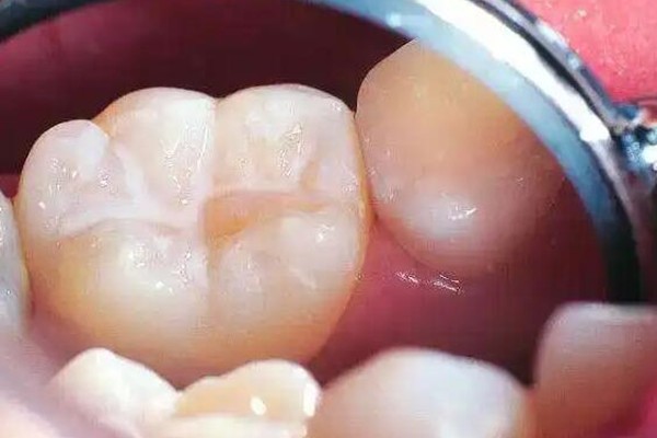 窝沟封闭几颗牙需要做,大概多少钱?小孩子窝沟封闭做一次管几年啊?