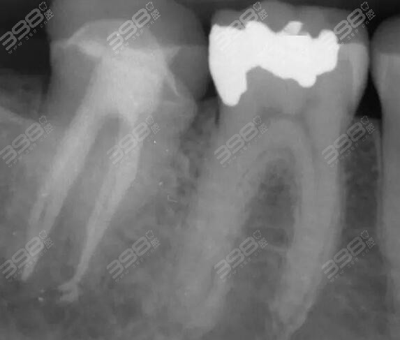 慢性牙髓炎和急性牙髓炎区别