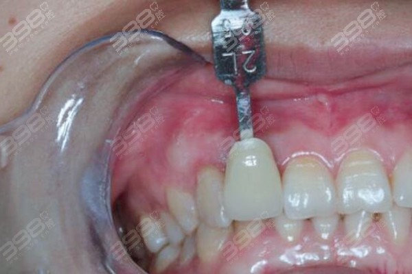 侧切牙根管治疗后需要做牙套吗