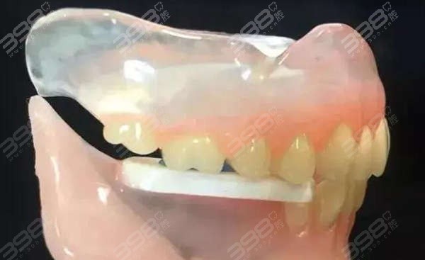 活动假牙的种类及价格-树脂假牙