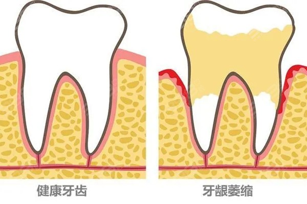 中年人牙龈萎缩怎么恢复？不同原因导致的萎缩恢复方式不同
