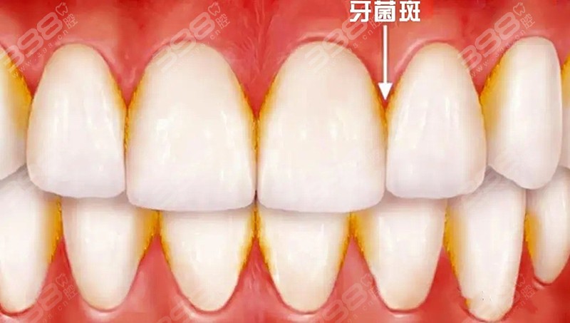 牙菌斑危害口腔健康