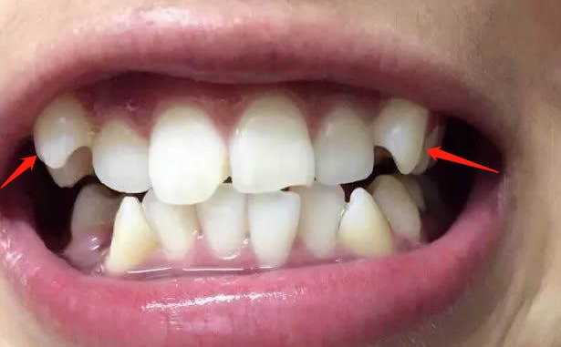 牙齿矫正时，两侧的虎牙需要拔除吗？