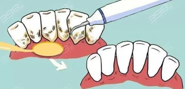 如何预防洗牙后牙齿酸软
