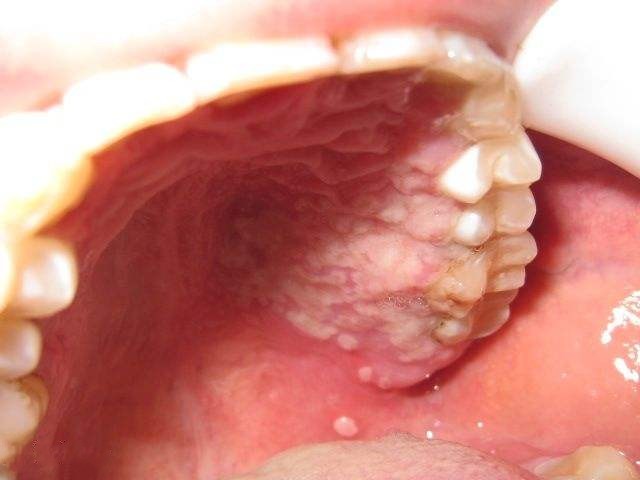 早上刷完牙，口腔中有一层白色粘膜是什么？