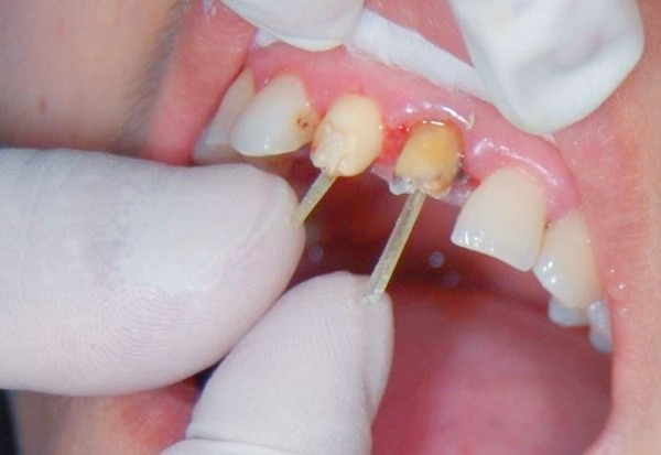 牙齿纤维桩多少钱一颗?如果做牙齿纤维桩容易断吗,使用寿命如何?