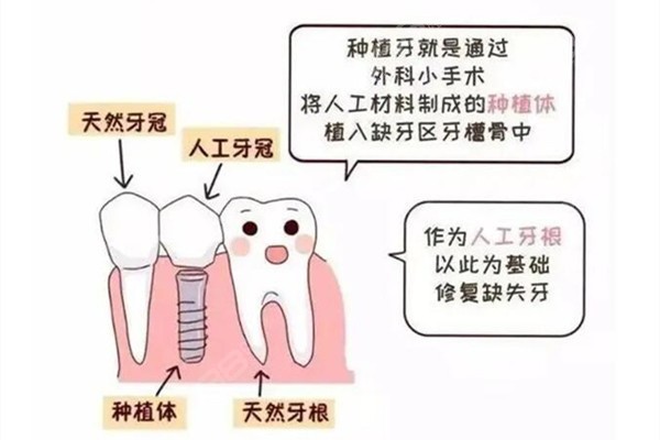 种植牙和原生牙有什么区别？种植牙会有什么不适？