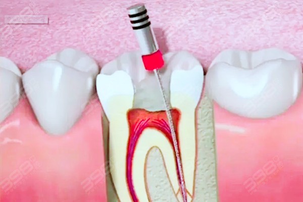 深圳牙齿根管治疗可以用医保吗？不仅可以刷医保根管治疗技术好