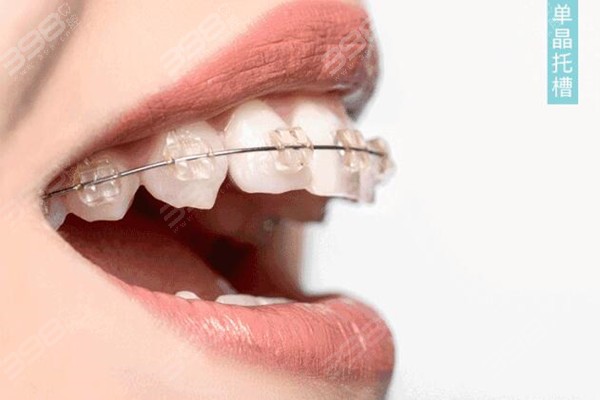 牙科医生告诉我牙齿矫正之前必须洗牙和补牙，是真的吗？