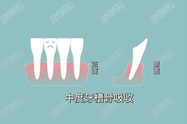 牙槽骨薄能做牙齿矫正吗？会不会导致出现牙齿松动？