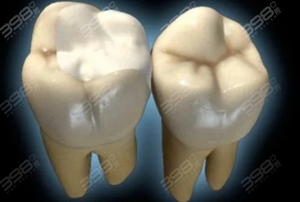嵌体补牙适合哪些牙齿情况使用