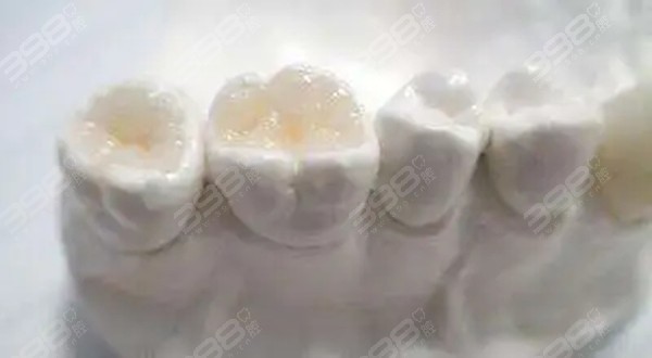 嵌体补牙和普通补牙的不同之处是哪里