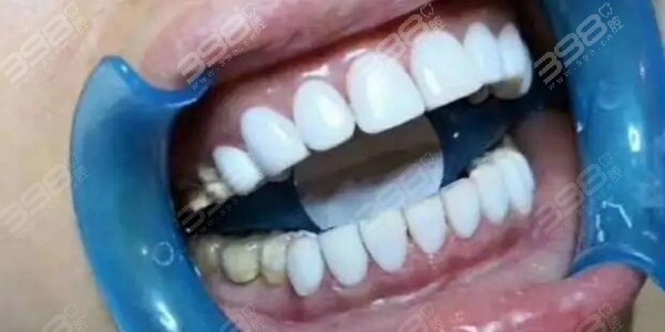 美牙师3d纳米浮雕牙
