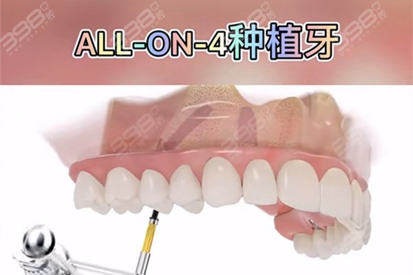 走遍了南京种植牙正规的口腔医院，弄出了这份南京半口种植牙价格表