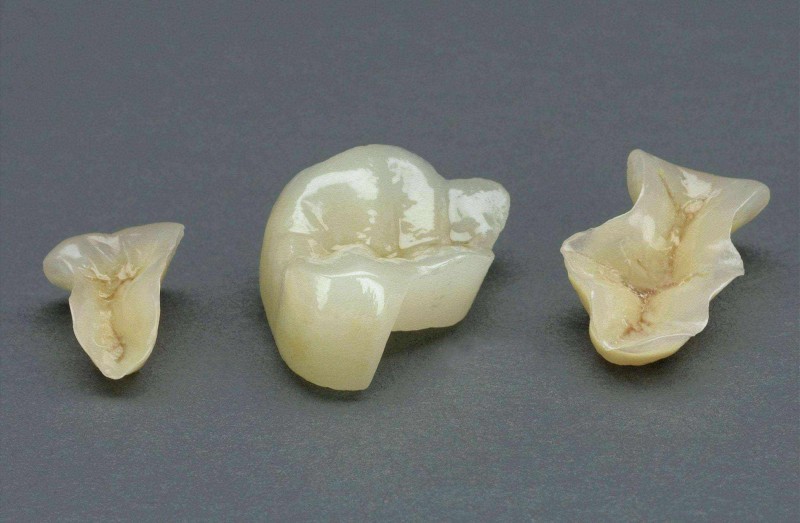 嵌体的种类有哪些？嵌体和传统补牙有什么区别？