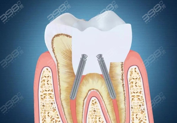 牙隐裂怎么预防？
