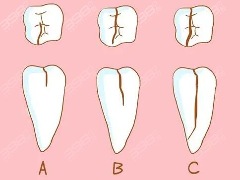 牙隐裂临床表现