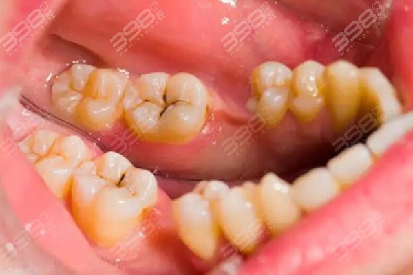 牙齿有小黑点需要补牙？