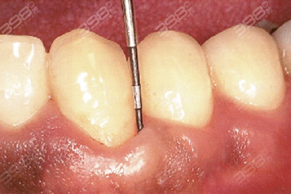 大部分情况下,牙周袋是由于牙齿长期清洁不到位,牙结石堆积形成的